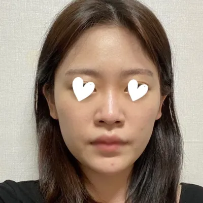 只做了一個鼻子手術就形象大變，心情真好 ❤️