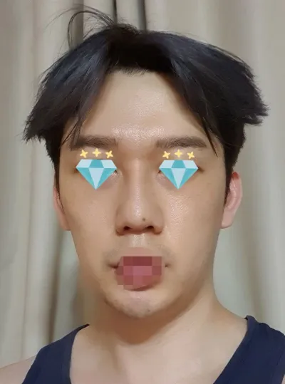 隆鼻好像大成功了 哈哈