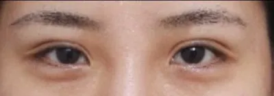 臘腸眼，再見了～