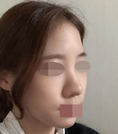 只打鼻部玻尿酸或是在猶豫要不要做鼻部手術的人，請一定不要猶豫，真心推薦做手術！真的非常非常推薦林院長！！