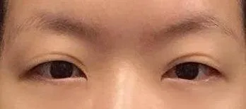 你好。手術至今已經過了6個月了。