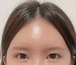 額頭拉提手術4個月心得~~