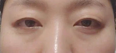 已經做完眼下脂肪重置手術超過三個月了。