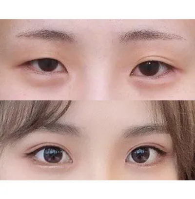 手術後已經三個月了。