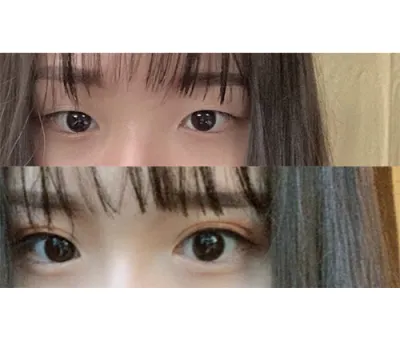 手術前很擔心眼睛有很多皺紋，但現在真的完全是我想要的樣子。