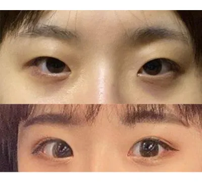 原本眼睛看起來很悶，現在那種悶悶的感覺真的完全消失了，真的非常滿意！！