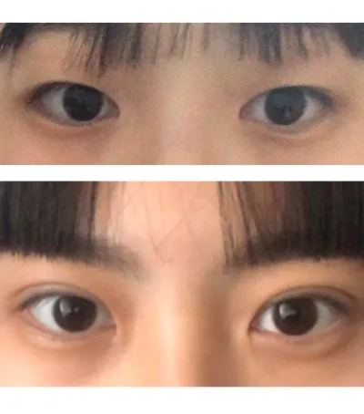 術後照片是做完雙眼皮手術約38天後的眼睛！