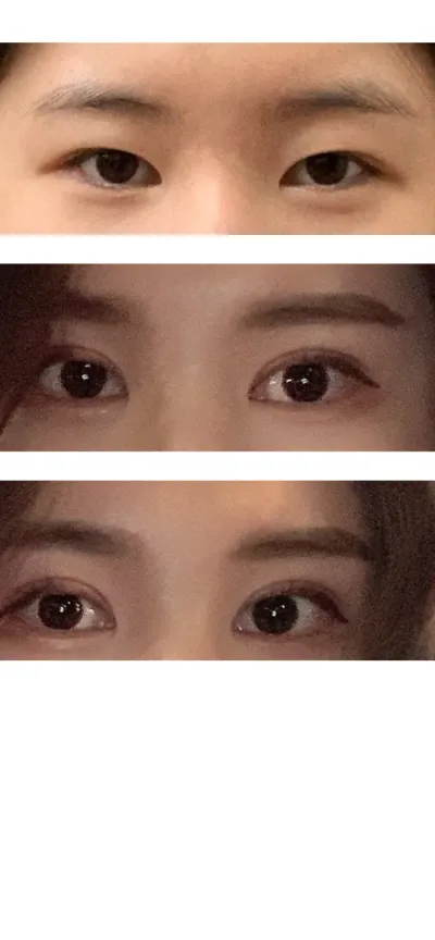 切開法雙眼皮重修、開後眼角及下至（切開式雙效開眼角）、切開式眼型矯正心得