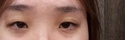 在 Very Good 整形外科做了第一次眼睛手術。