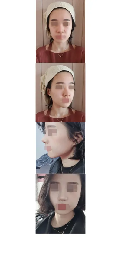 除了鼻塞不舒服之外，其他都很好！