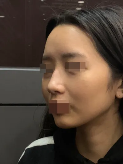 在 Very Good 做了第一次隆鼻手術！Very Good！