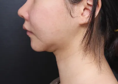 拆線和術後管理都做得非常細心，因為抽脂不會復胖，有抽脂困擾的人推薦去 Very Good 看看喔。