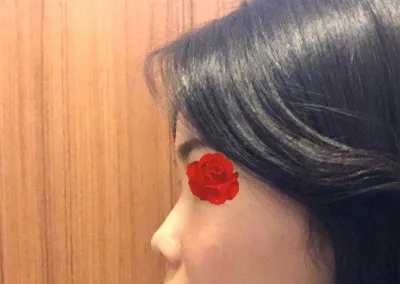 我覺得如果是找其他院長動手術的話，絕對做不出這種高度，所以我絕對不後悔~~!!