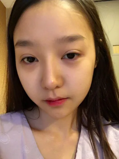 我做了眼睛重修，這次做了鼻子重修。