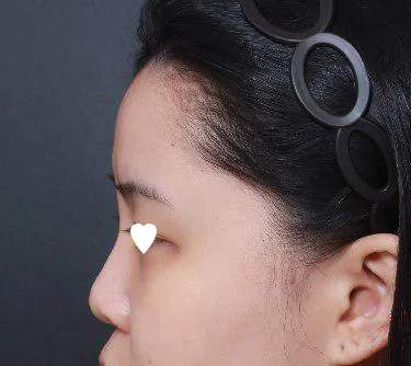 找林煐岷院長做了鼻子手術唷哈哈