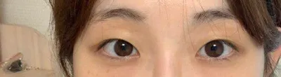 第一次雙眼皮手術自然黏連、開前眼角心得！