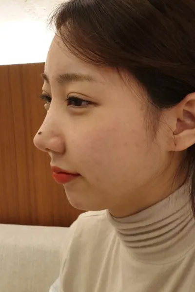 因為有點下巴後縮，所以做了下巴手術！！