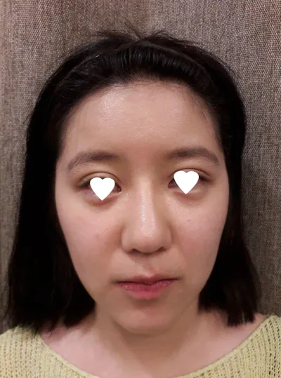 做了顴骨、長曲線、下巴、鼻修復手術。