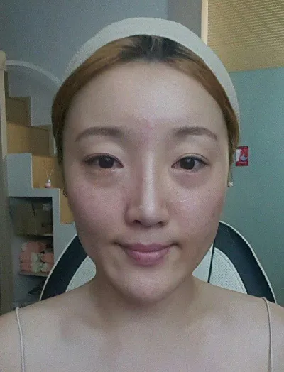 雙眼皮、眼底脂肪重置、輪廓三項，三個月後記。