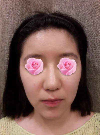 手術完2個月了，做了鼻修復、輪廓、顴骨、長曲線下顎角和下巴。