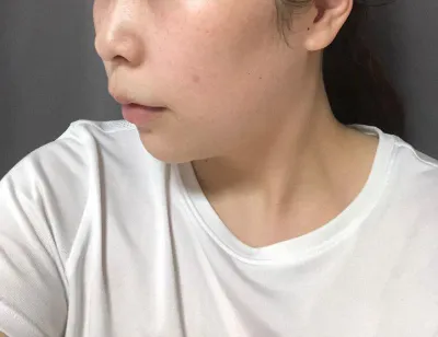 雙下巴、下顎線臉部抽脂一個月後的心得～