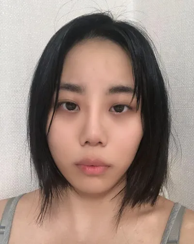 現在消腫了，變成了我夢寐以求的線條，眼睛自然地變大，真的非常非常滿意ㅠㅠ