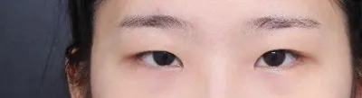 雙眼皮手術心得！！