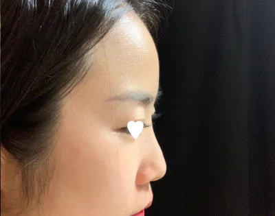 周圍的人也都說線條很漂亮，大家都誇瘋了！哈哈哈，這就是我想要的鼻尖線條，嗚嗚，謝謝您。