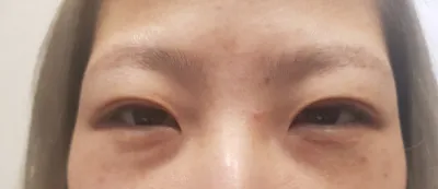 我找金俊亨院長做了切開式雙眼皮重修手術～
