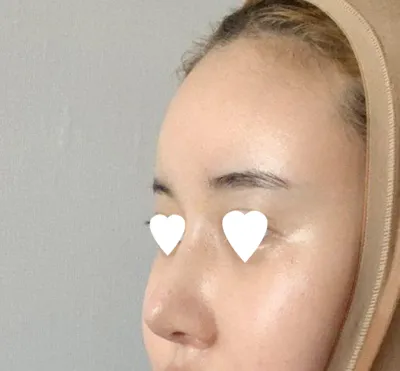 院長是在林榮敏院長那裡做的鼻子修復手術！！！