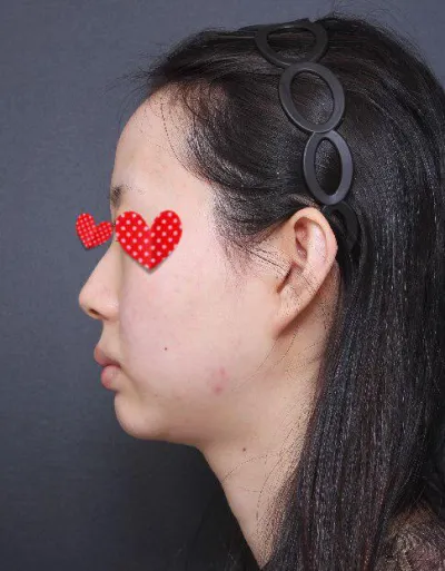 隆鼻、脂肪移植第3週，之前因為蒜頭鼻、鷹鉤鼻、額頭凹陷和下巴所帶來的壓力全都消失了。