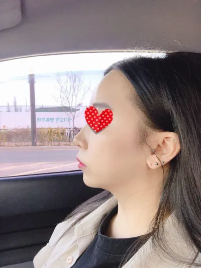 4月9日在 Very Good 整形外科做了全臉脂肪移植喔～