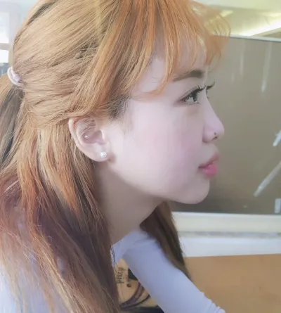 雙眼皮、自然黏連、提肌、開眼角（前、後、下），全都開了！