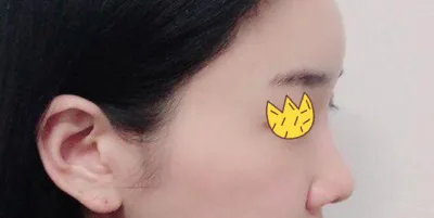 隆鼻修復第3個月囉^^