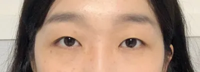 分享雙眼皮手術心得！！哈哈