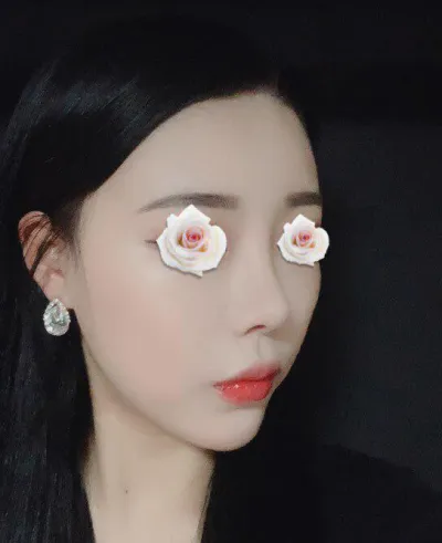 給林榮敏院長做完鼻整形手術已經一個月了。