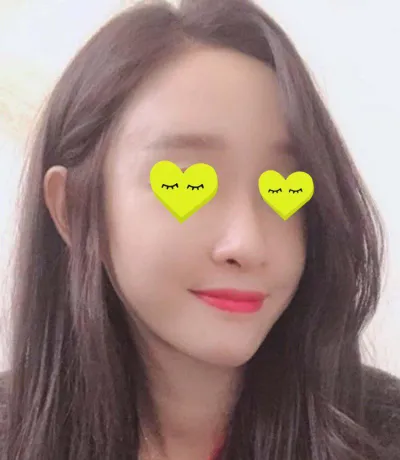 在金俊賢院長那裡做了全臉脂肪移植！