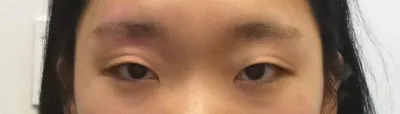 做完割雙眼皮、開內眼角手術已經超過兩個月了。