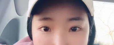 做了眼尾下至重做手術哈哈