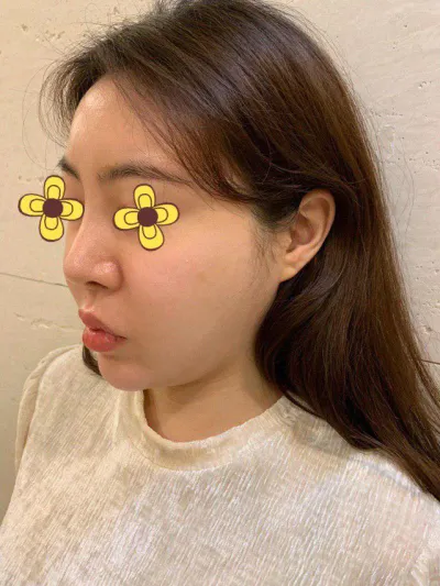 幸好做了埋線拉提ㅠㅠ