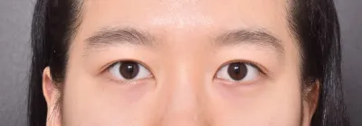 眼睛修復手術很成功ㅠㅠ