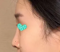 做完隆鼻手術已經63天囉～