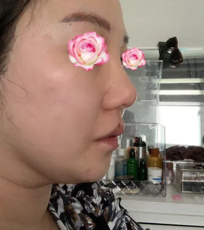 在 Very Good 整形外科做了隆鼻手術。