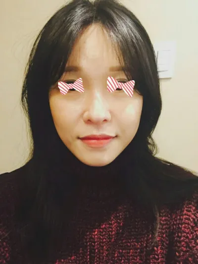 臉部自體脂肪移植！