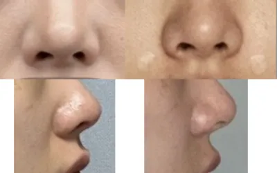 [**顧客] 法令紋填充劑手術後記