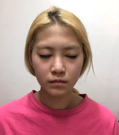 鼻部 | 脂肪 | 其他 手術後記