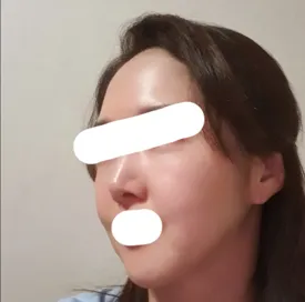 拉提 | 脂肪手術心得