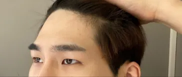 眼部 | 拉提手術心得