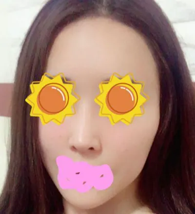 臉部輪廓 | 其他手術心得