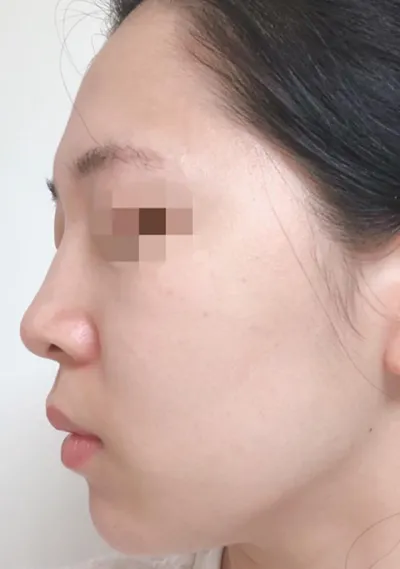 脂肪 | 其他手術後記